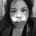 Day 1 - nose, upper/lower lids, and chemical peel around eyes and mouth.  Looks worse than it is!