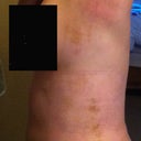After - 3 days after procedure.  With my arm stretched up, the fat appears to be completely gone, but there is some that stayed behind