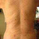 Back - after procedure.