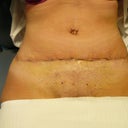 Day 9 PO dressings re-dressed....old tan lines now showing as being pulled downwards plus my 2 freckles that were either side of my tummy bottom are now just a tad above my cut line
