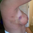 The worst of my bruising.