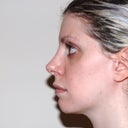 1 year 4 months post-op.  Approx. 12 weeks since in-office procedure.