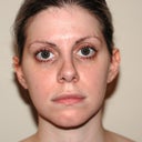 1 year 4 months post-op.  Approx. 12 weeks since in-office procedure.