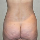38 Year Old Female Treated For Stomach And Waistline Fat