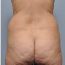 38 Year Old Female Treated For Stomach And Waistline Fat