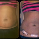 Be4 and after front shoots.. 1 week after