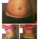 The day Before my Smart Lipo ...