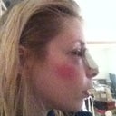 next day, the tape from my under nose bandages left two pink stripes on my cheeks.