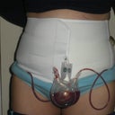 This was me PO days 1 through 9.  Waiting to see what could be under there!!!
