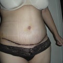 MY belly day 10!  My scar is very low.  My bb looks really tiny.  It will be interesting to see if it changes as it heals.