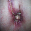 my belley buttin took a whioe to heal dr alswo aske i keep in for 2 weeks longer