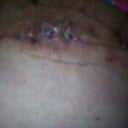 i had 2 spots above pelvic are that took a whie to heal now everyone kept saying put neosporin on it well you know what helpd me sleeping with out garmet and leaving it dry