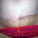this is how myb wounds look now....