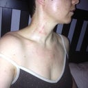 The day of the treatment