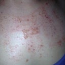 The day after the treatment