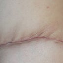 04/26/13-PO 3 WEEKS-left side scar
