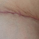 04/26/13-PO 3 WEEKS-right side scar