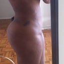 4.5 weeks after surgery. Sorry for the nudity, I hope no one is offended
