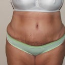 12 Days Post Op