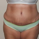 12 Days Post Op