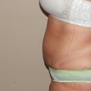 12 Days Post Op