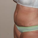 12 Days Post Op