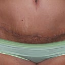 12 Days Post Op of the Scar