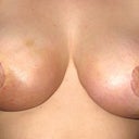 Three weeks + one day - Post Op