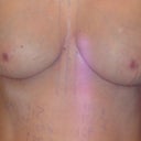 One day after surgery