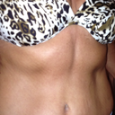 6 months post op