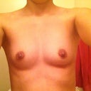 Day before surgery no bra bare front view