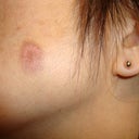 1 week after VI Precison booster peel