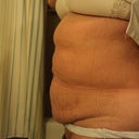 3-4 weeks before surgery