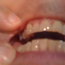 Before, note chips on bottom of two front teeth.