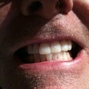 After, no chips, whitening is likely harder to discern.