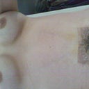 This shows my incision and bruising. My stomach barely hurt at all at first, but is tender to the touch now.