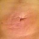 lying down looks the best, but I'm still numb in a lot of areas 2 months later