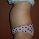 4 weeks post op side view, still have the large hematoma sticking out (PS said to expect it to lessen over the next 3 months)