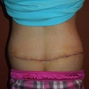 1 week post op back view, still have those love handles but much better