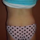 4 weeks post op back view, cannot believe how good my butt looks now!  It is more shapely as a side effect of the circumferential TT