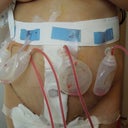 Couple of days post op