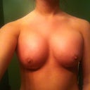 6 weeks post op