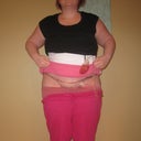5 days post op - one drain out one still in