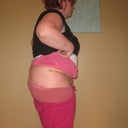 5 days post op - one drain out one still in