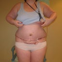 7 days post op - still one drain in