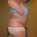 7 days post op - still one drain in