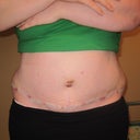 11 days post op - drain free and fresh steri strips - stitches removed from belly button