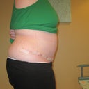 11 days post op - drain free and fresh steri strips - stitches removed from belly button
