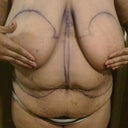 Night before surgery. Letting it all hang. YUCK GROSS!!