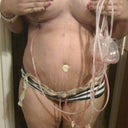 3 days post op. Tummy very swollen.